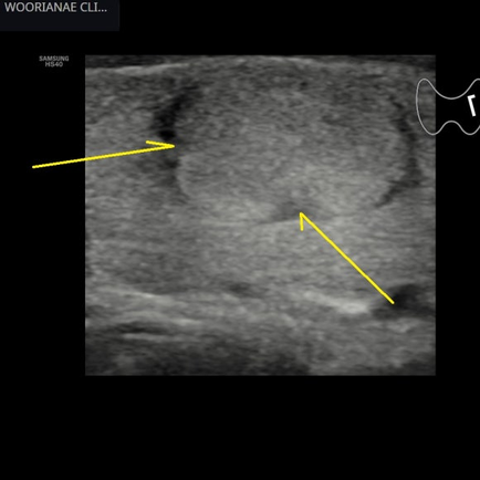 크기 변화가 있는 갑상선 결절, 여포성 종양... 가능성 - 동대문구 답십리, 은평구, 우리안애 우리안愛 내과