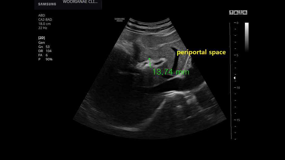 과거 C형 간염 치료자의 간암검진, 일부 영향이 있는 소견, 과거의 간섬유화? - 동대문구 답십리, 장안동, 우리안애 우리안愛 내과