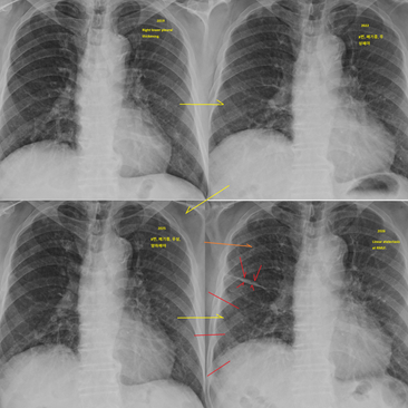 아주 먼 과거의 폐결핵 환자, 약간의 객혈과 흉부사진의 변화가 확인/판단되니 추가검사 의뢰 - 동대문구 답십리, 전농동, 우리안애 우리안愛 내과