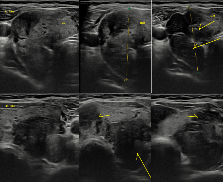 시시각각 변화하는 갑상선 모습, 하시모토 갑상선염의 활동기? 겹친 무통성 갑상선염 현상일지... - 동대문구 답십리, 제귀동, 우리안애 우리안愛 내과