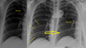폐렴 + 후비루, 기침에 기여하는 각각의 정도는? 흉부소견 호전의 확인, 원래 땀이 많아.. 판단에 헷갈릴수도.. - 동대문구 답십리, 광장동, 우리안애 우리안愛 내과