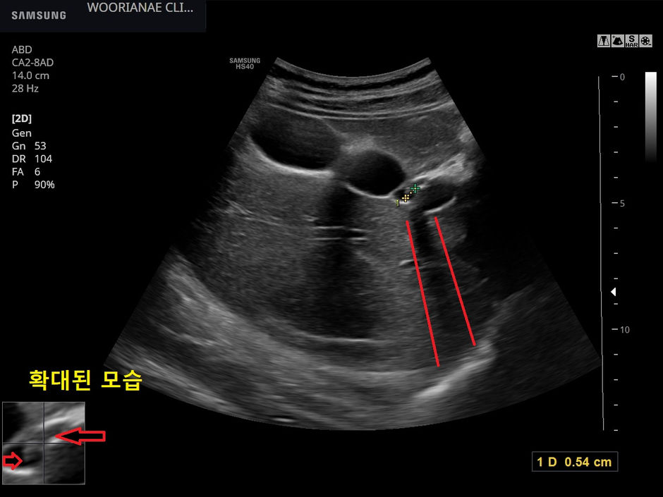 담낭기원 통증, 산통이 강하게 의심되나 초음파에서 담석 소견의 재확인이 안될때... - 동대문구 답삽리, 장안동, 우리안애 우리안愛 내과