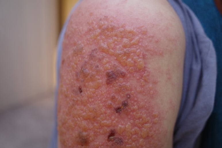 방관하는 당뇨 배경에서 매우 심한? 대상포진의 발생 - 동대문구 답십리, 전농동, 우리안애 우리안愛 내과