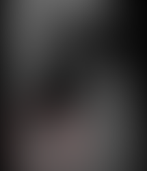 이차 고혈압 검사시 우연히 발견된 척추 압박 골절 소견, 어릴때 낙상에 의한?