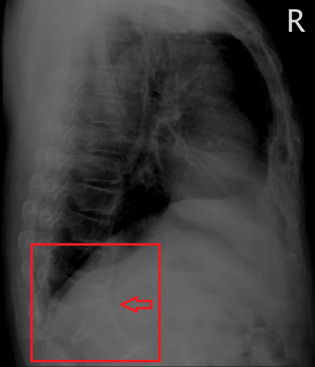 이차 고혈압 검사시 우연히 발견된 척추 압박 골절 소견, 어릴때 낙상에 의한?