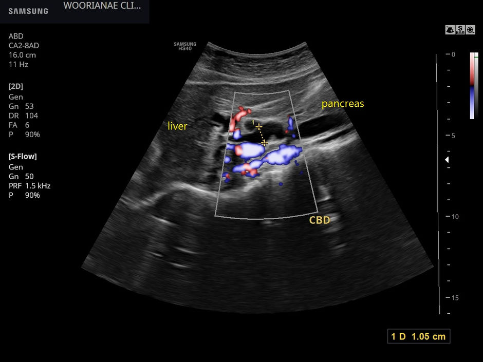 임신에 의한 담석? 무증상 담석에서 2개월 뒤 총담관 폐쇄를 일으켜 증상 발생 - 동대문구 답십리, 장안동, 우리안애 우리안愛 내과, 초음파 클리닉