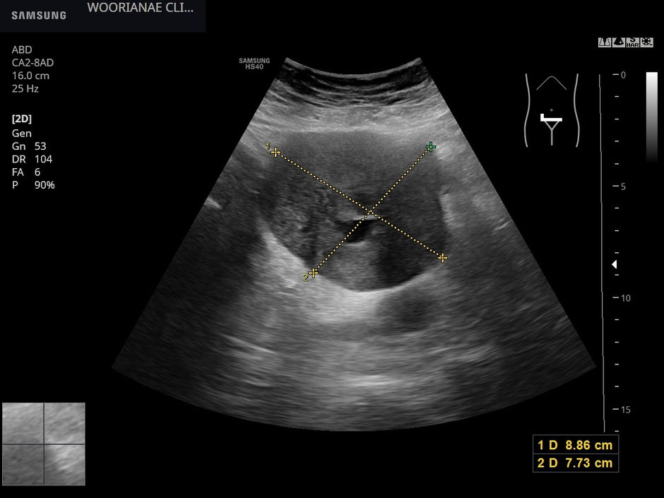 좌측하복부 통증, 게실염 걱정하며 내원... 게실염 배제후 골반저 종양, 난소? vs. 소장 GIST (위장관 기질종양)? - 동대문구 답십리, 청량리동, 우리안애 우리안愛 내과