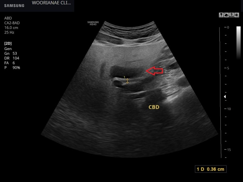 복부, 간 초음파; 심한 지방간에서 종괴처럼 관찰되는 국소성 지방결여 (focal fat sparing)
