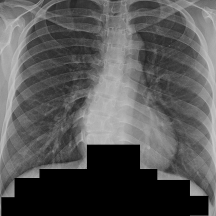 폐렴 유무과 상관없이 항생제를 사용하고 있으니 기존 의원 추적하도록 안내 - 동대문구 답십리, 전농동, 우리안애 우리안愛 내과