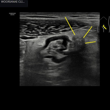 염증성지방변화의 범위가 아주 작은 게실염, 장골동맥의 압박에 의한 통증과 구별이 필요 - 동대문구 답십리, 전농동, 우리안애 우리안愛 내과