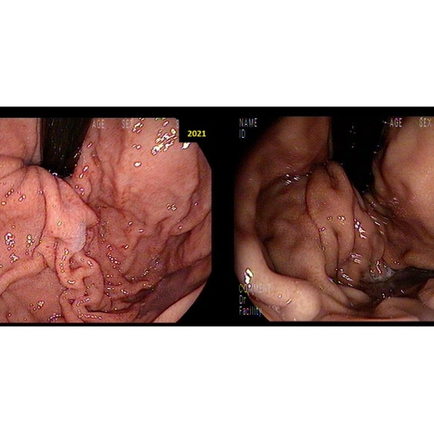 제균 후 내시경의 추적, 육안적으로 제균 여부 확인, 2년전 검진은 건너뛰었으나... - 동대문구 답십리, 전농동, 우리안애 우리안愛 내과