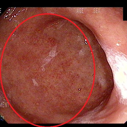 단기적 증상이 아니나 증상에 연관될 정도의 위염 소견의 구별 - 동대문구 답십리, 용두동, 우리안애 우리안愛 내과