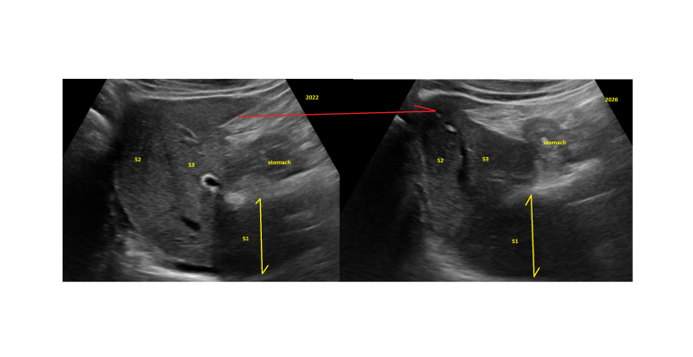 지방간 배경에서 간모양의 변화, 4년 추적중 최근에야? - 동대문구 답십리, 전농동, 우리안애 우리안愛 내과