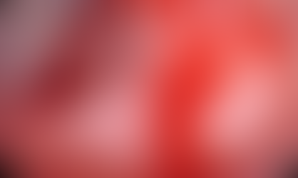 복통을 동반하지 않은 다량의 항문 출혈, 급성 활동성 게실 출혈 사례