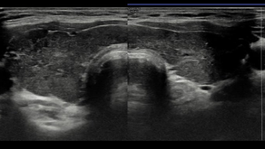 갑상선 초음파; 산후 갑산선염, postpartum thyroiditis