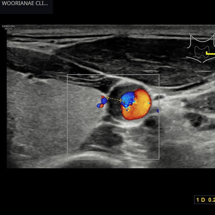 목의 증상에 대해 평가중 우연히 발견된 경동맥 동맥경화, 흡연력의 확인 - 동대문구 답십리, 용답동, 우리안애 우리안愛 내과 