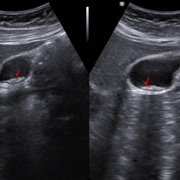 복부, 담낭초음파; 출산 후 상복부 경련성 통증으로 내원한 담석/담낭 오니 (gallbladder sand stones)