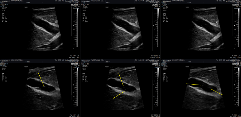 1. 담낭/담석 질환의 증상 및 초음파 소견의 스펙트럼이 넓다. 명확한거에서 미묘한... 2. 잠깐의 인연의 소개로 내원 - 동대문구 답십리, 숭인동, 우리안애 우리안愛 내과