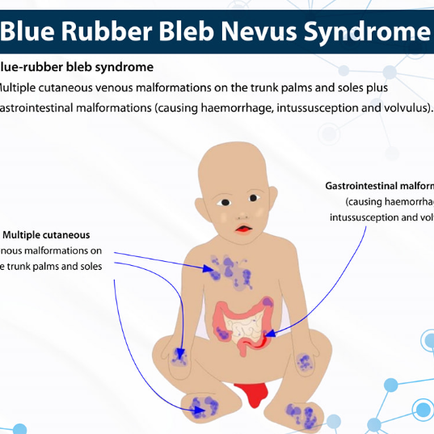 Blue rubber bleb nevus syndrome(BRBNS), 청색 고무 수포 모반 증후군을 만나다 - 동대문구 답십리, 능동, 우리안애 우리안愛 내과