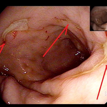 창백하고 컨디션이 안좋아보이는 환자의 검진, 빈혈 패턴이 궤양과는 맞지 않아 혈액내과 진료 필요하나 추적 소실 - 동대문구 답십리, 감이동, 우리안애 우리안愛 내과