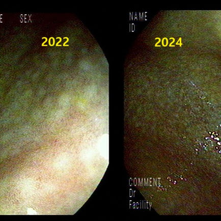 해외주재원? 가족, 외국에서 국가검진 등 위해 귀국, 결절성 위염의 헬리코박터 제균 후 추적 등 - 동대문구 답십리, 용답동, 우리안애 우리안愛 내과