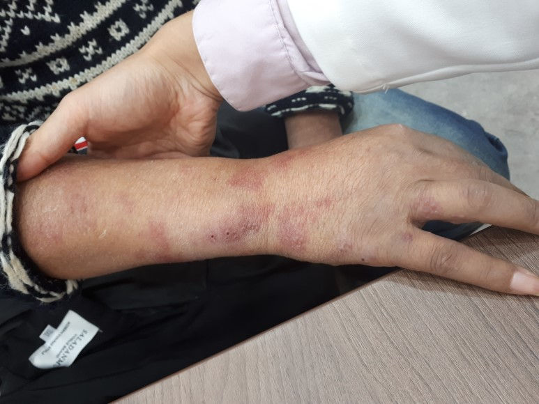 알콜장애, B형간염 간경화 환자, 피부병변으로 외진; C6~7을 침범한 대상포진