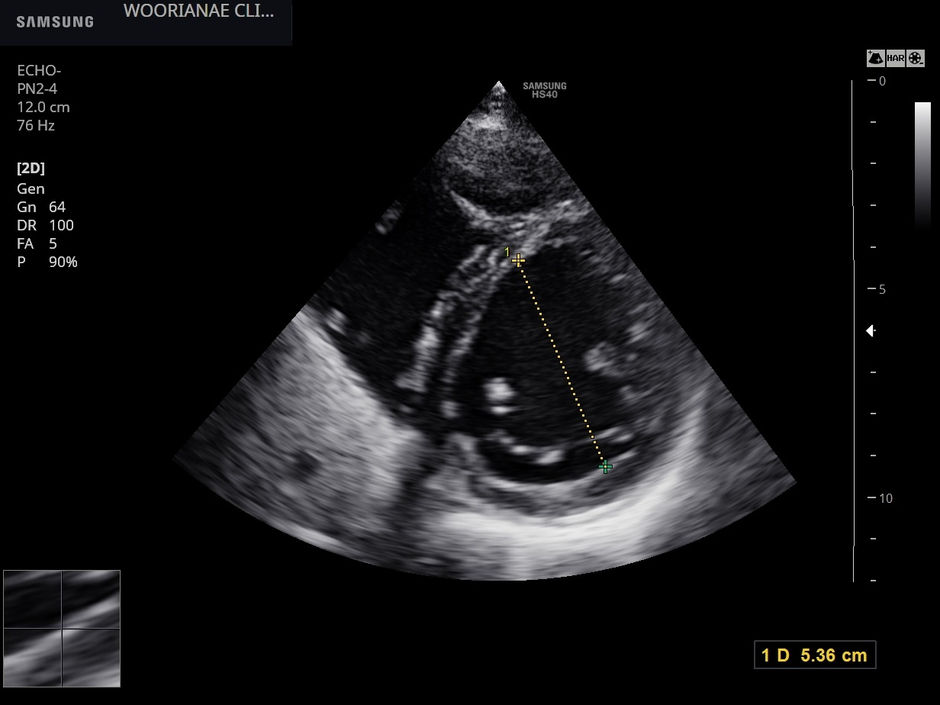 접종 후 심근염 의증; 혈액검사는 정상이나 증상과 경도의 심실 확장에서 확진검사 상담위해 의뢰 - 동대문구 답십리, 전농동, 우리안애 우리안愛 내과