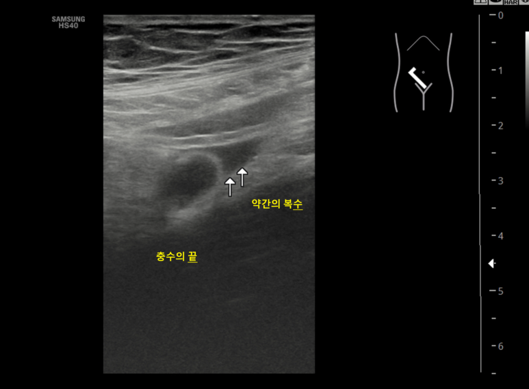 양치기 소년 취급받을 뻔하다 (2). 과거는 정상, 이번엔 충수염 - 동대문구 답십리, 전농동, 우리안애 우리안愛 내과