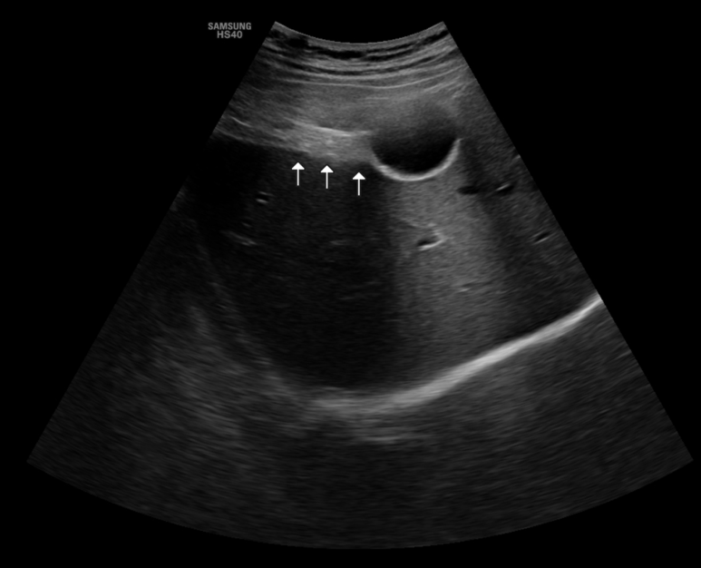 B형간염도/위험음주자가 아닌데 간경화 설명의 시작? 지방간/지방간염의 결과로 봐도 될지 (3), 재진; 초음파 변화가 인지됨 - 동대문구 답십리, 장안동, 우리안애 우리안愛 내과