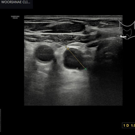 부갑상선 낭종, 혹은 부갑상선 낭종성 선종 의증; 부갑상선항진증은 없음을 확인 - 동대문구 답십리, 전농동, 우리안애 우리안愛 내과