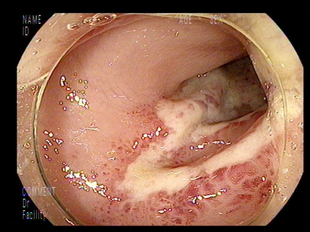 약간의 복통과 한번의 혈변.. 증상은 약하나 허혈성 장염 - 동대문구 답십리, 장안동, 우리안애 우리안愛 내과