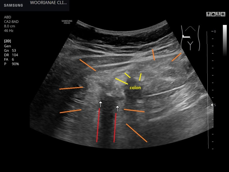 같은날 게실염 (3); 호전중이라면서 입원?, 촉진상 압통범위가 넓고 반발압통까지! - 동대문구 답십리, 전농동, 우리안애 우리안愛 내과