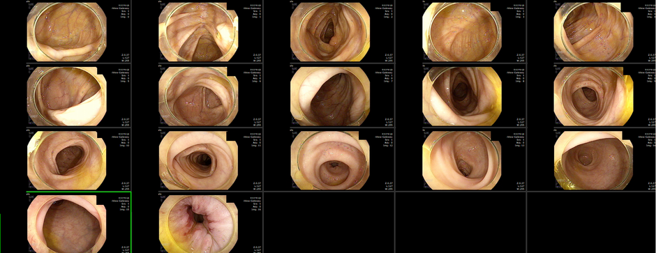 중증 근무력증 (myasthenia gravis) 환자에서 생애 최초 대장내시경 시행 - 동대문구 답십리, 전농동, 우리안애 우리안愛 내과