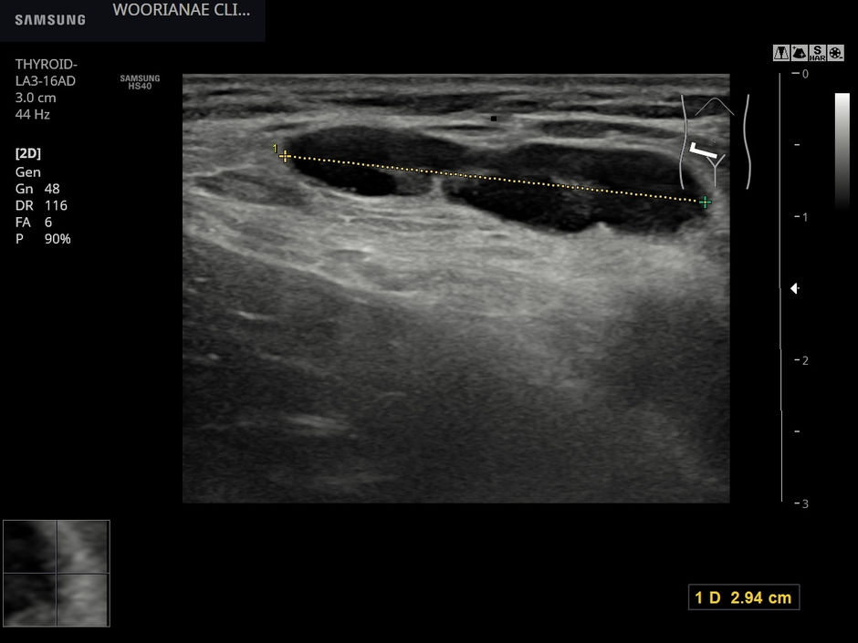진단을 방해하는? 길고 긴 과거 증상의 기술 (2)... 단순포진에 의한 반응성 서혜부/사타구니 림프절 고려 - 동대문구 답십리, 장안동, 우리안애 우리안愛 내과