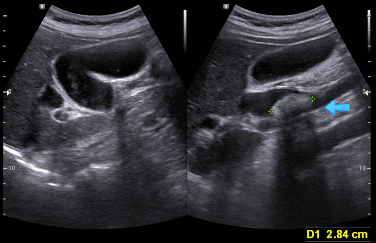 복부, 담관 초음파; 과거의 무증상 총담관 담석이 크기가 변화하면서 복통과 간수치 상승 유발