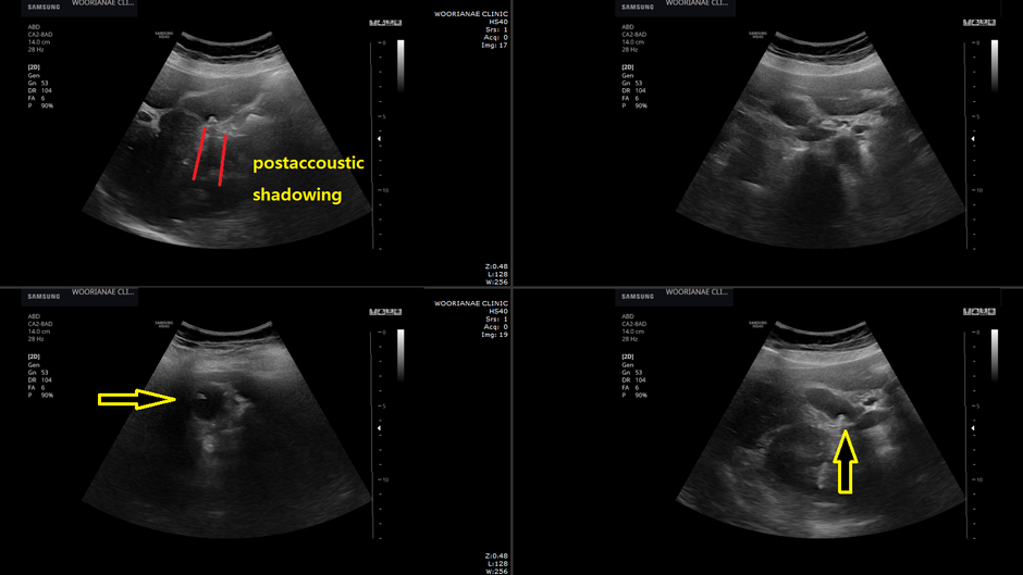 과거 정상 신장기능이지만 신장 크기가 작었던... 과거 용종으로 기술된 것은 담석이었으며... - 동대문구 답십리, 도봉구, 우리안애 우리안愛 내과