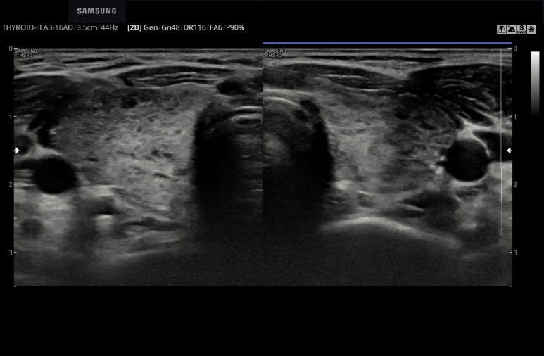 과거 갑상선 항진증 기왕력, 임신시 갑상선 저하증 호르몬 투약, 출산후 항진증 상태; 산후갑상선염 의증