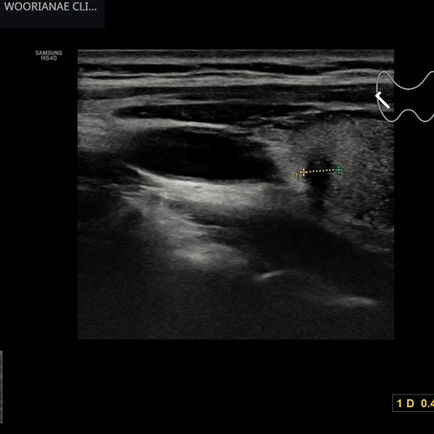 우연히 발견된 갑상선 결절, 걱정되는 양상 (2) - 동대문구 답십리, 전농동, 우리안애 우리안愛 내과