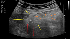 같은날 게실염 (2); 10년에 7번째, 컨벡스로 잘 보이는 - 동대문구 답십리, 전농동, 우리안애 우리안愛 내과