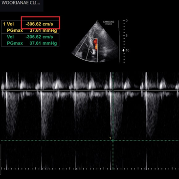 우심실만 커진? 중증의 삼천판 역류와 폐동맥 고혈압의 확인, 각도에 따른 소견의 차이 - 동대문구 답십리, 전농동, 우리안애 우리안愛 내과