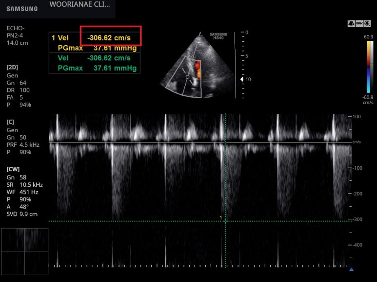 우심실만 커진? 중증의 삼천판 역류와 폐동맥 고혈압의 확인, 각도에 따른 소견의 차이 - 동대문구 답십리, 전농동, 우리안애 우리안愛 내과
