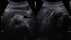 복부 초음파; 전내장역위증 (situs inversus totalis)