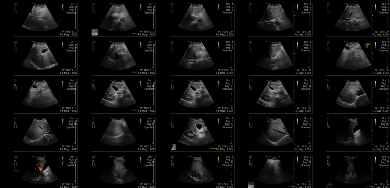 지속 음주자에서 매우 높아지는 rGTP의 모습, 앞으로는? - 동대문구 답십리, 전농동, 우리안애 우리안愛 내과