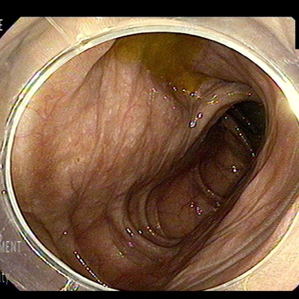 여러 가루 음식을 수년간.. 대장흑색증과 연관성은? - 동대문구 답십리, 용답동, 우리안애 우리안愛 내과