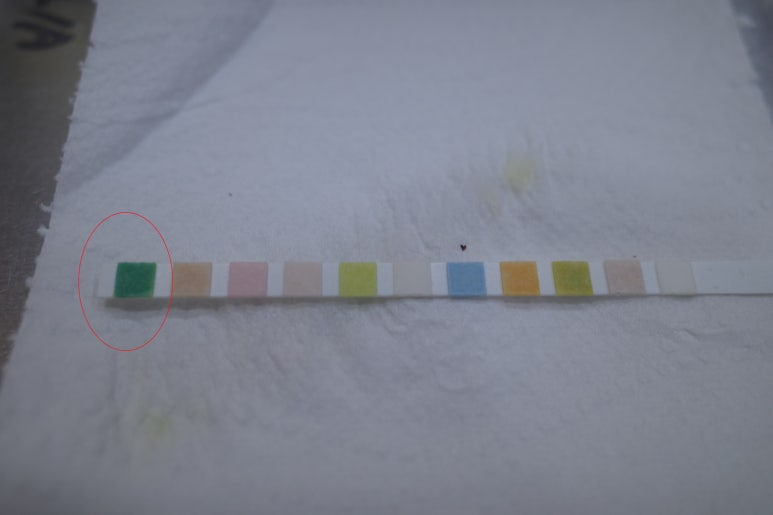 초기에 고열과 오한, 소변증상은 약하나 의미있는... 복잡 요로감염의 판단, 배양음성 - 동대문구 답십리, 전농동, 우리안애 우리안愛 내과