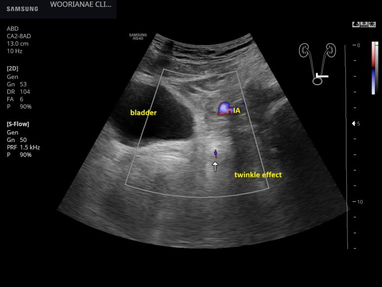 육안적 혈뇨, 과거와 같은 통증이 아니라 요로결석이라고 생각하지 않으며 방문, 수신증/요로 확장이 없는 방광요도이행부 결석 - 동대문구 답십리, 전농동, 우리안애 우리안愛 내과
