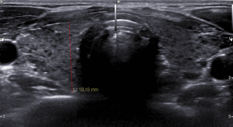 갑상선 초음파; 진행하는 갑상선염 소견과 동반된 크기 변화가 있는 림프절