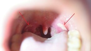 세균성 인후염의 판단 (3), 최근의 편도염, 그리고 다시 연구개쪽 궤양의 발생 - 동대문구 답십리, 전농동, 우리안애 우리안愛 내과