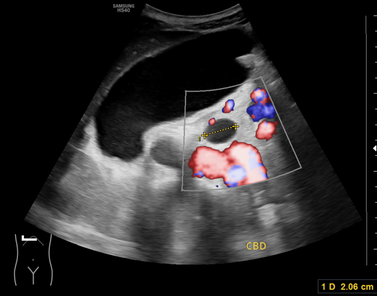 복부, 담도/담낭 초음파; 간내 담도 확장, double duct sign, 총담관 확장; 원위부 총담관 벽 비후 및 폐쇄