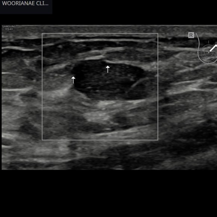 기본이 안되어 있는 검진센터/체계, 유방암 검진에 대한 조언 - 동대문구 답십리, 전농동, 우리안애 우리안愛 내과